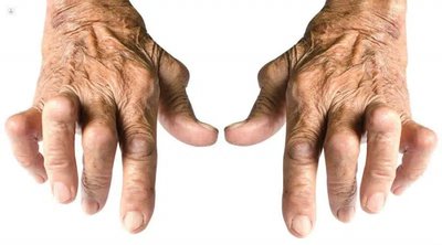 Artritis reumatoide: cules son sus causas?