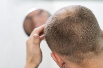 Qu es la alopecia areata?